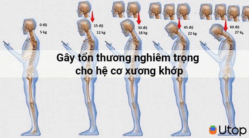 Gây ra những tổn thương nghiêm trọng cho hệ cơ xương