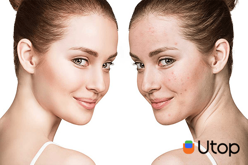 Chăm sóc da mụn cơ bản phải biết