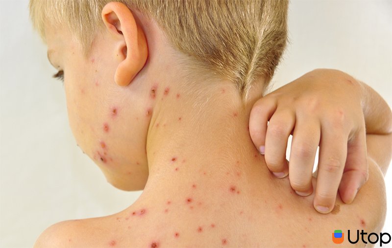 Điều gì gây ra bệnh đậu mùa?