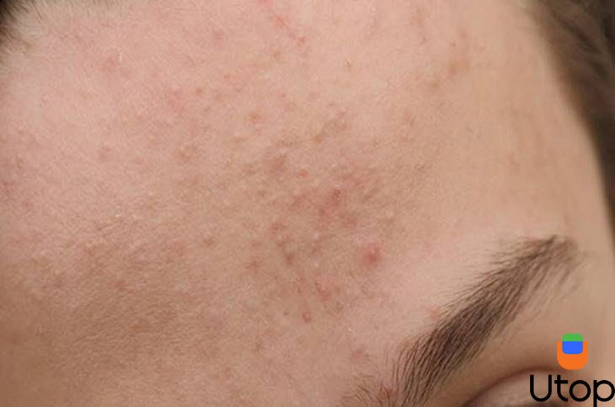 Lý giải có nên tẩy tế bào chết cho da dầu mụn và da bị mụn không?