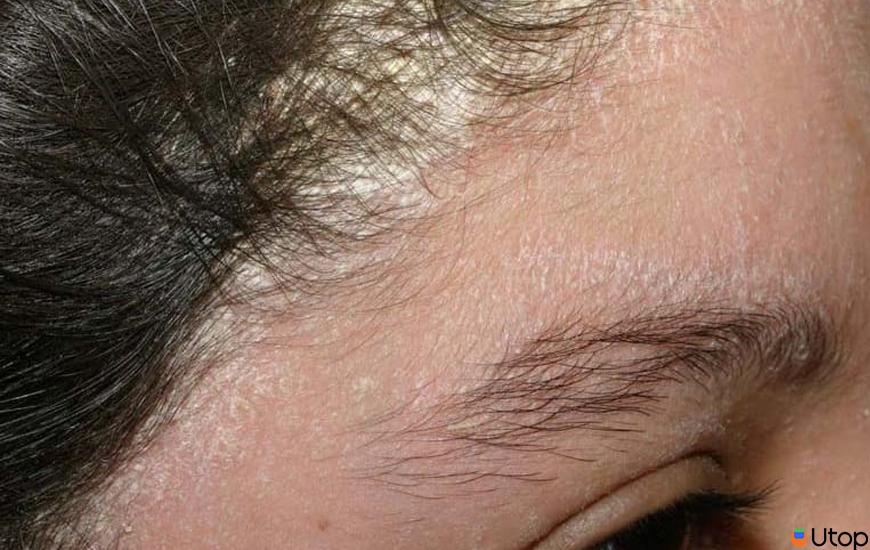 3. Cách khắc phục nấm da đầu 