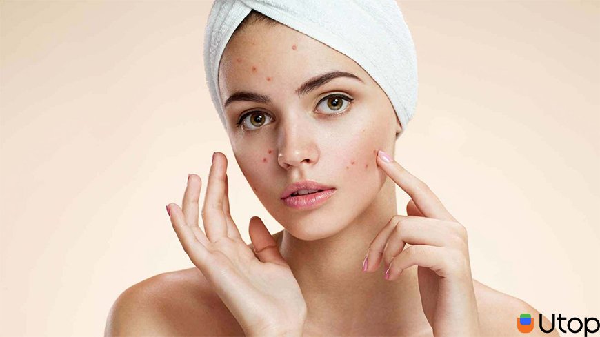 Mặt có nhiều mụn