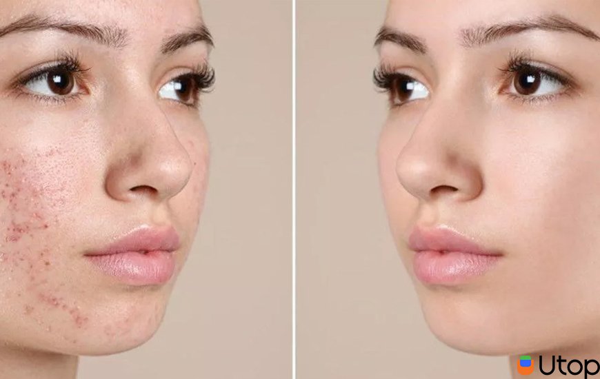 .  Cách điều trị mọi loại mụn 
