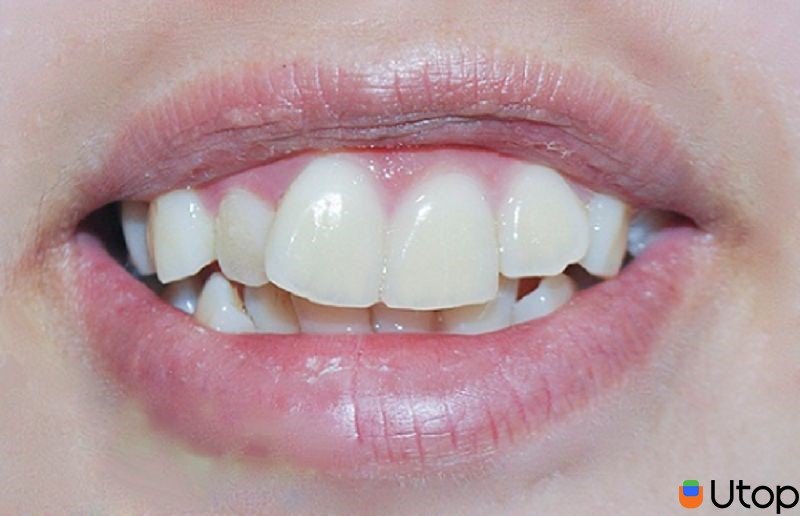 Những trường hợp cần niềng răng