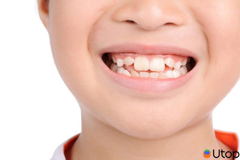 Tại sao niềng răng là giải pháp tốt nhất?