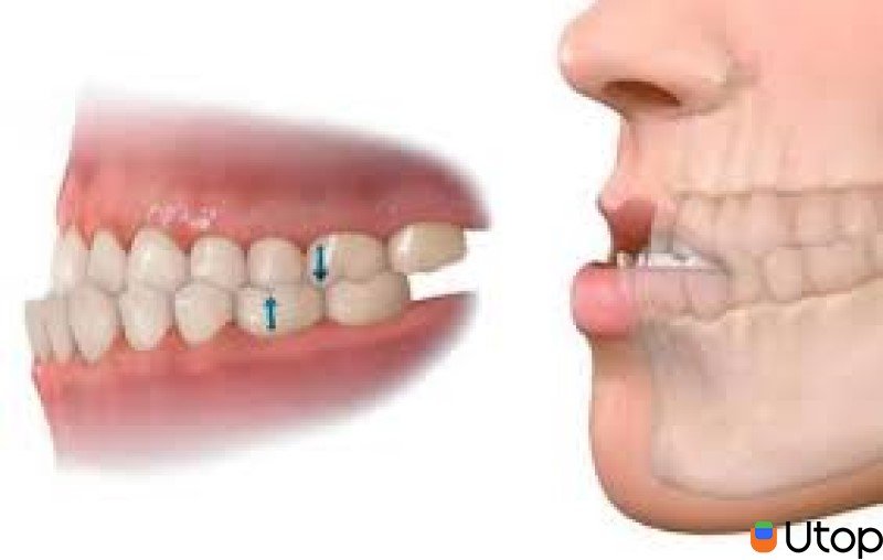 Những trường hợp cần niềng răng