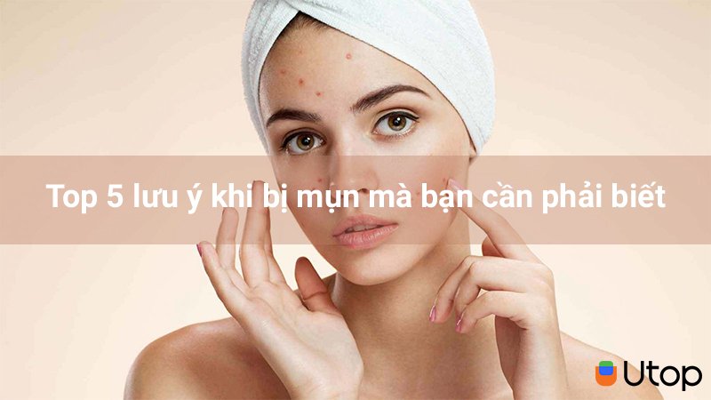 Top 5 lưu ý khi bị mụn mà bạn nên biết để chăm sóc làn da của mình