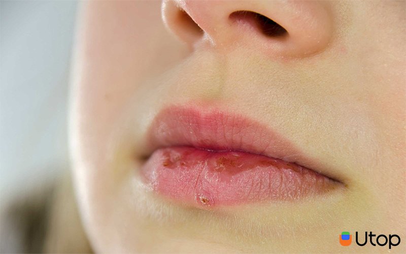Tại sao môi thường khô và nứt nẻ vào mùa đông?