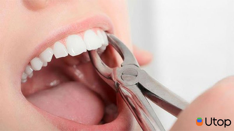 Nhổ răng có cần niềng không?