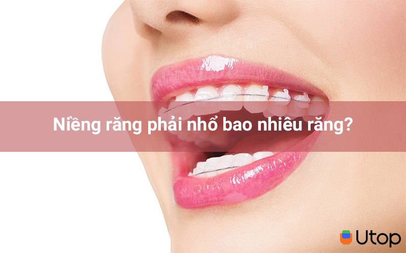 Nếu có thì nên nhổ bao nhiêu răng?