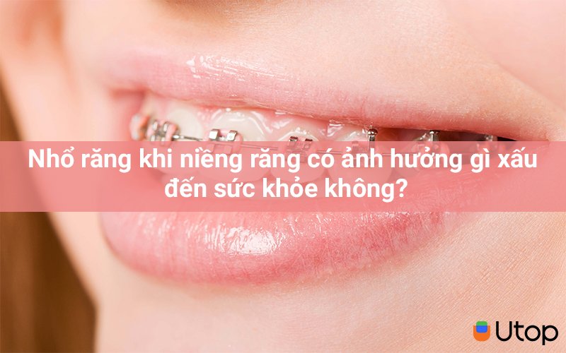 Nhổ răng bằng khí cụ có hại cho sức khỏe không?