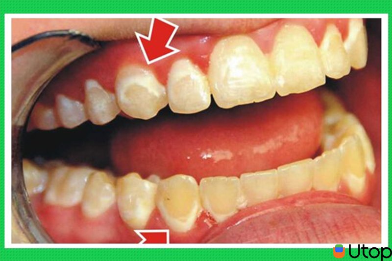 Tổn thương men răng, ngà răng