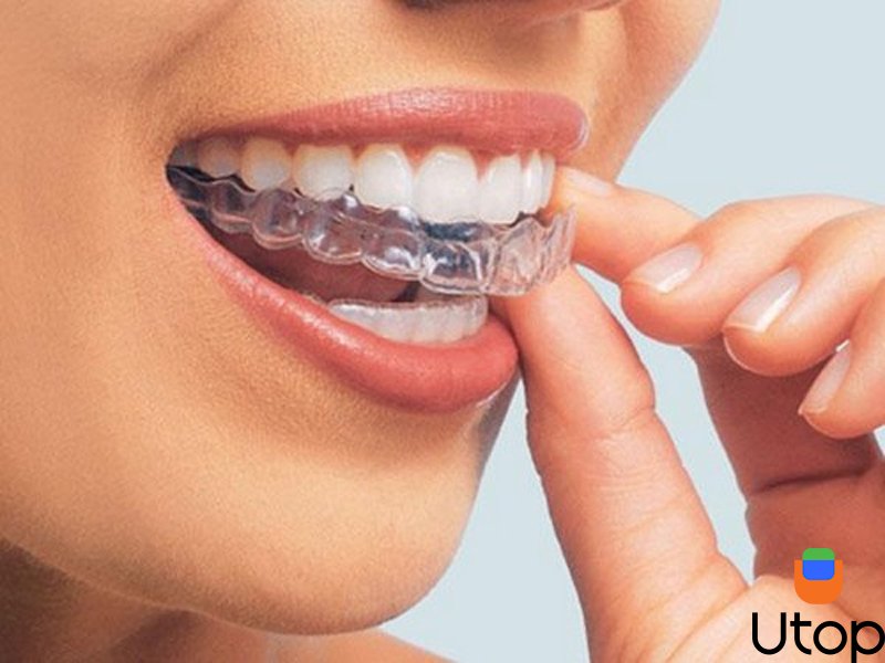 Lợi ích của niềng răng trong suốt là gì?