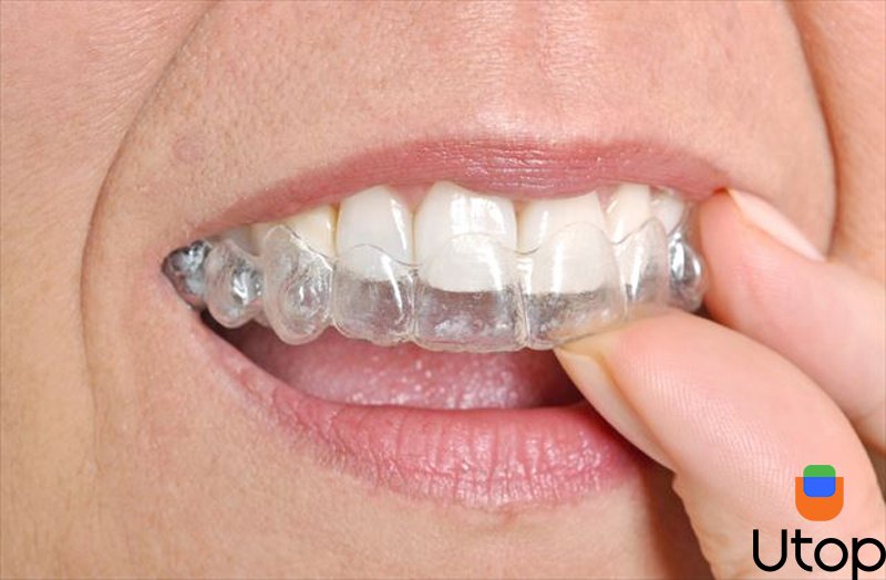 Xu hướng niềng răng trong suốt mang lại cho bạn hàm răng đều đẹp và thẩm mỹ